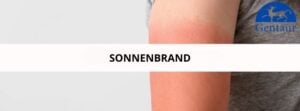Sonnenbrand wie kann man sicher in der Sonne spielen Hauptbild des Artikels