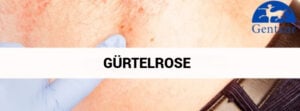 Was ist Gürtelrose? hauptild des artikels